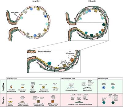 Insights Into Development and Progression of Idiopathic Pulmonary Fibrosis From Single Cell RNA Studies